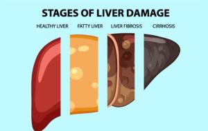 Liver Cirrhosis | AFD Pharma